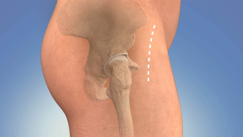 Revision Total Hip Joint Replacement Surgery in Ahmedabad