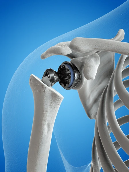 Best Shoulder Replacement Surgery in Ahmedabad